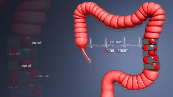简析几种需要注意的结肠癌的危害