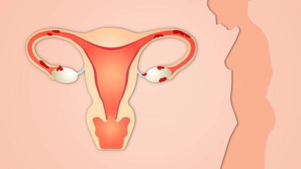 诱发宫颈癌的因素都有哪些