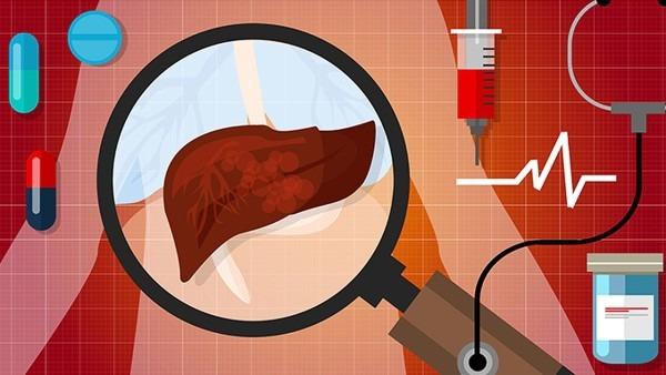 肝癌的3个最佳治疗方法