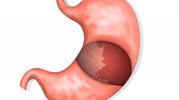 胃癌的早期征兆有哪些