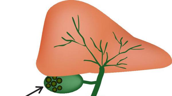 预防胆管癌必知注意事项