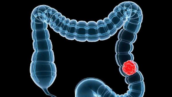 直肠癌患者一定要尽早知道其临床表现
