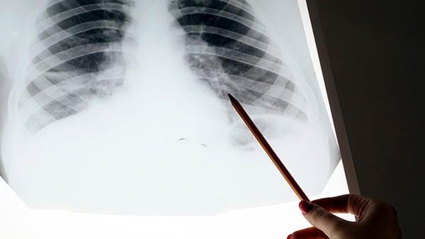 预防肺癌必知的三个主要事宜