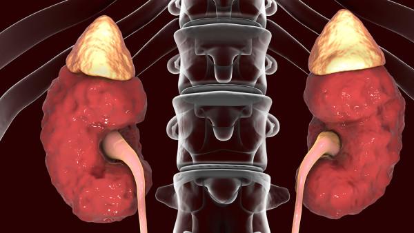 肾柱肥大和肾癌如何区别