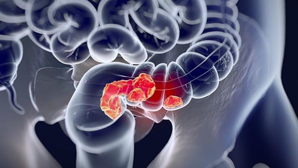 45岁结肠癌怎么预防复发