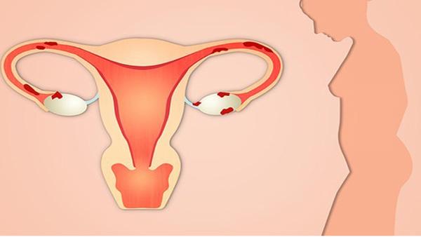 功能失调性子宫出血是女性子宫癌的症状