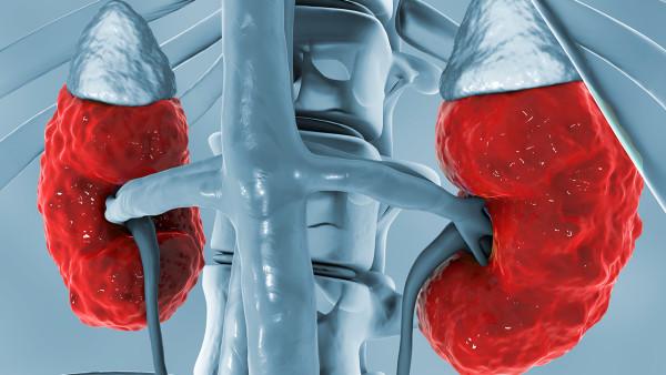 专家解析不同类型肾癌的治疗方法