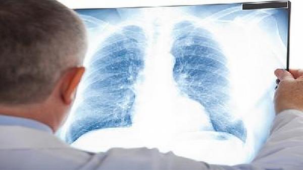肺癌的疾病通常应怎样去预防发生