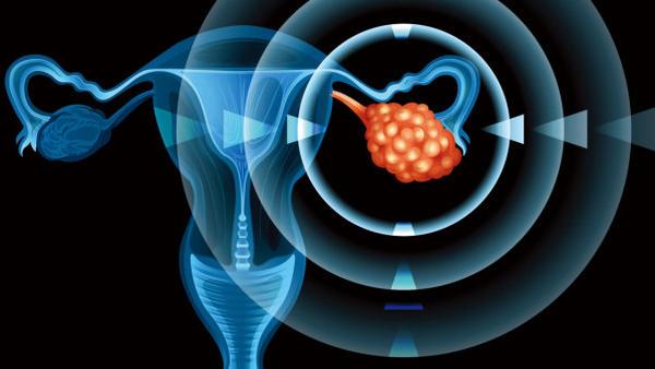 卵巢癌后怀孕会受影响吗