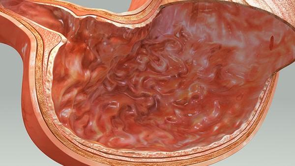 胃癌的遗传异质性是否决定了肿瘤细胞的侵袭和转移能力