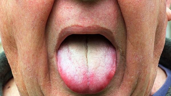 舌癌一般是多少度传染人