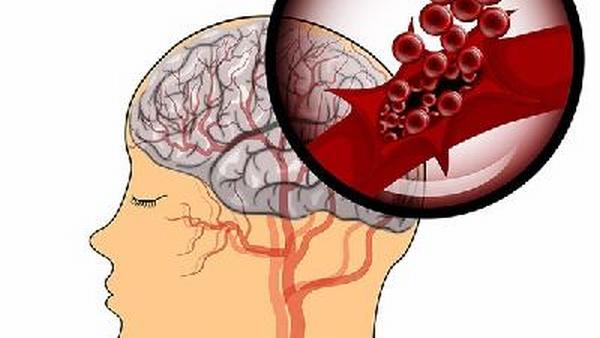 甲状腺结节钙化胶质瘤是什么