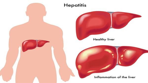 肝癌的引起原因是什么
