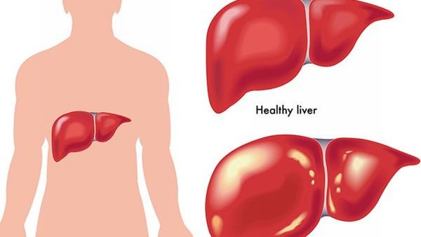 男子患肝癌是什么病