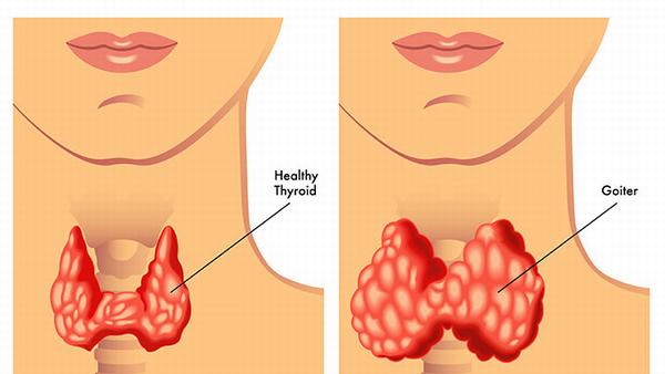 甲状腺癌全切六年tsh多少正常