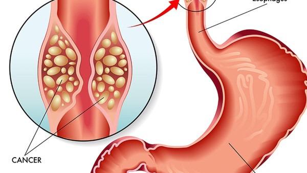 胃癌的危害是否会影响患者的外貌