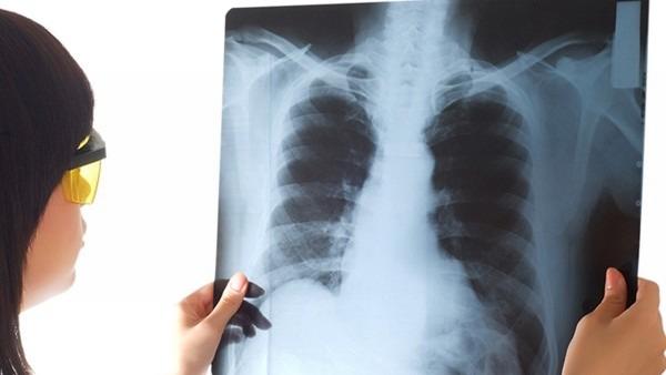 肺癌晚期刚开始化疗为什么发烧