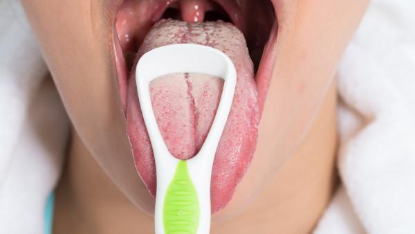 舌癌遗传是什么意思