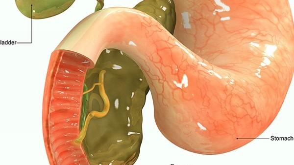 胃癌的避免是否与慢性炎症有关