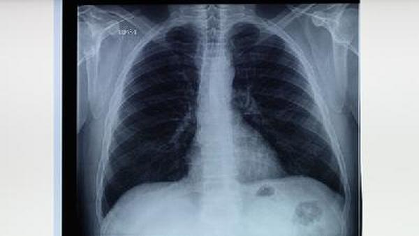 15岁的孩子为什么得肺癌