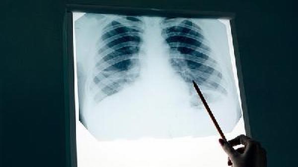 肺癌的早期预防有哪些