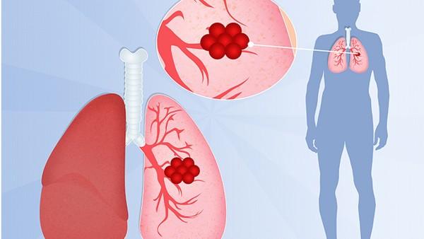 宫颈癌转移肺有什么靶向药