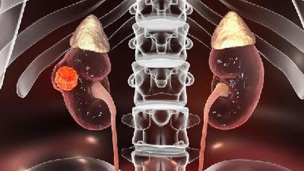右肾癌转移到肾怎么办