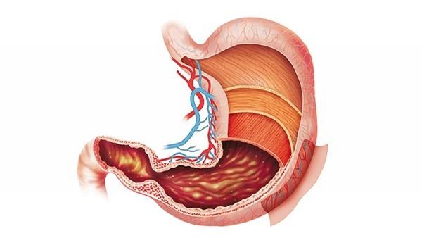 胃癌三期吐酸水怎么回事