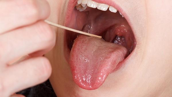 舌癌的治愈多少钱