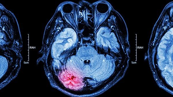 脑瘤脑梗前兆有哪些症状