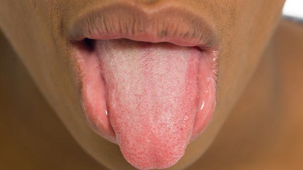 舌癌患者如何锻炼