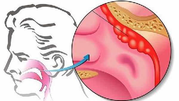 鼻咽癌和鼻炎有什么区别呢