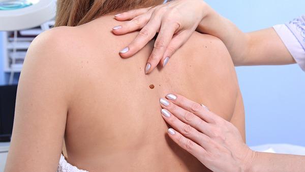 皮肤癌的危害性是什么