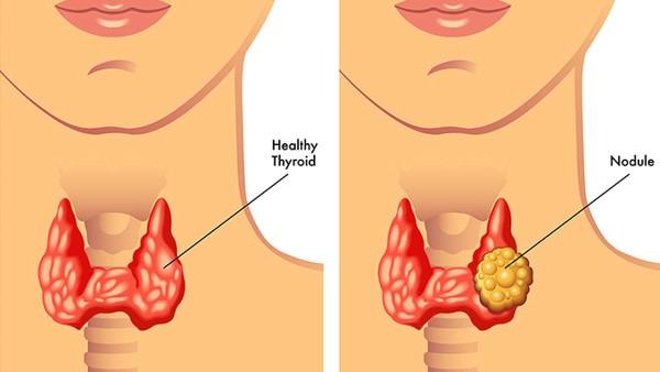 甲状腺癌怎么样要碘伏消毒