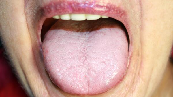 舌癌放疗后怎么去锻炼