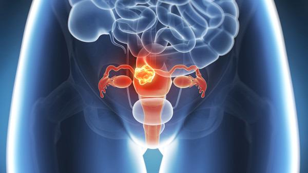 怀孕卵巢癌复发怎么办