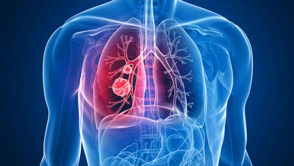 如何防治肺癌