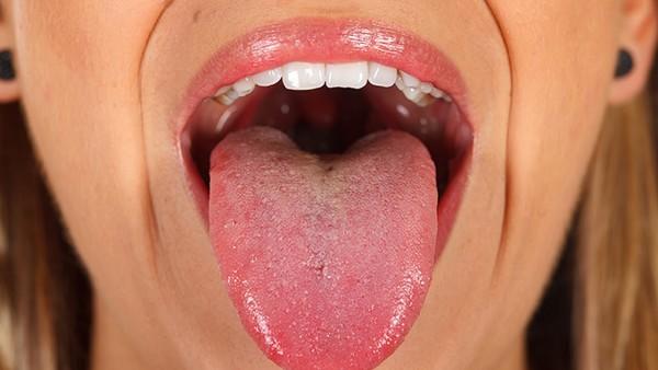 舌癌医生怎么发现