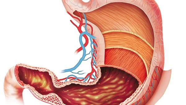 慢性胃炎如何预防变成胃癌