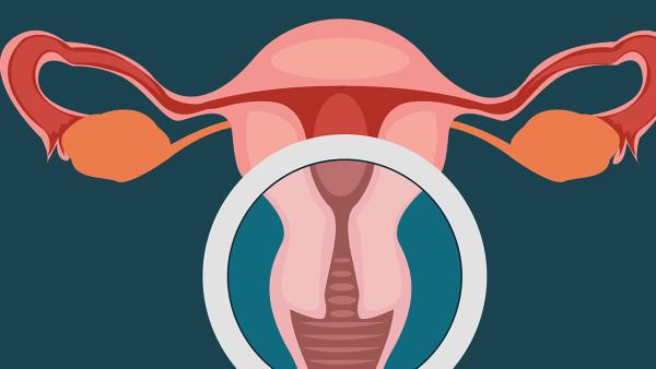 确诊卵巢癌有哪些手段