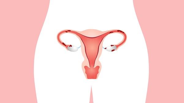 怎么确诊是卵巢癌
