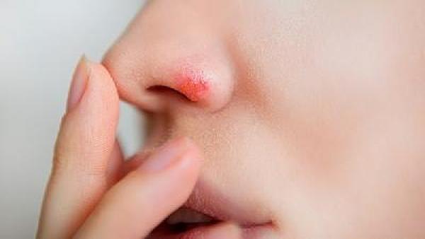 如何预防早期鼻咽癌