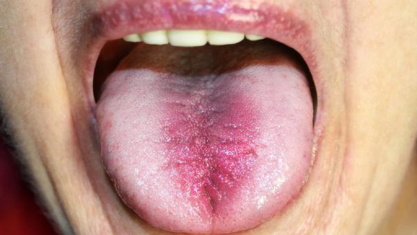 舌癌做什么检查最佳时机