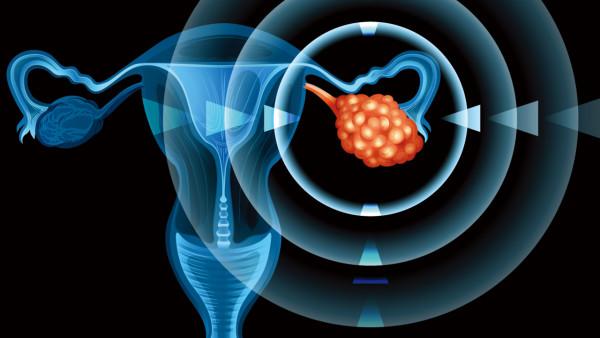 国内每年有多少认患卵巢癌