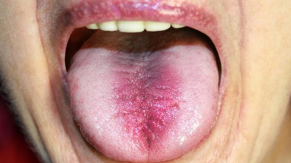 舌癌复查做什么检查