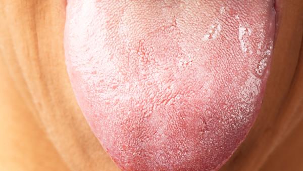 舌癌有什么症状和疾病