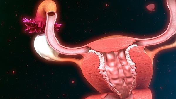 高分化卵巢癌1a期会复发率是多少