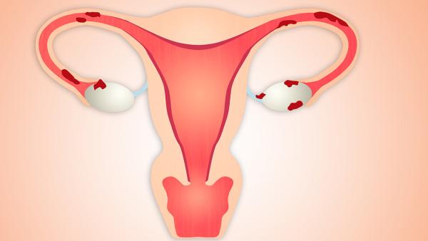 卵巢癌手术后怎么经常背胀