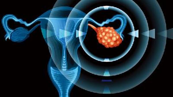 卵巢癌有什么表现呢