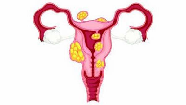 哪些症状说明卵巢癌晚期